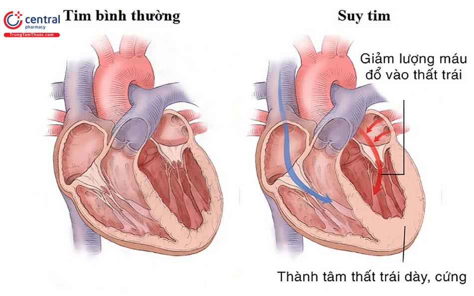 Suy tim