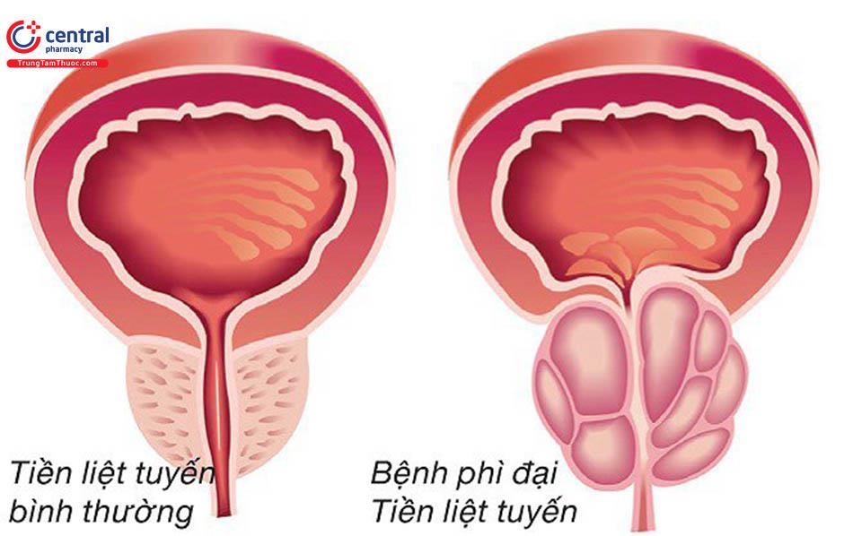 Tăng sản tuyến tiền liệt lành tính