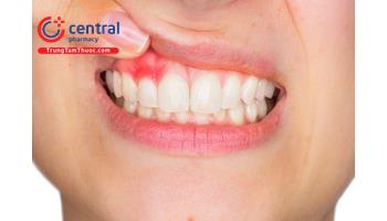 5 thuốc bôi chữa tụt lợi chân răng hiệu quả. Chữa tụt lợi hết bao nhiêu tiền?