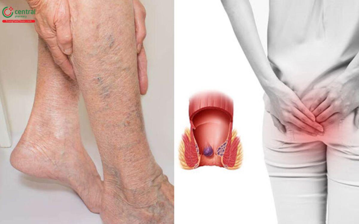 Thuốc trị trĩ và suy giãn tĩnh mạch