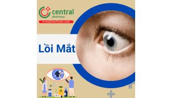 Tổng quan về bệnh lồi mắt và các biện pháp điều trị lồi mắt hiện nay