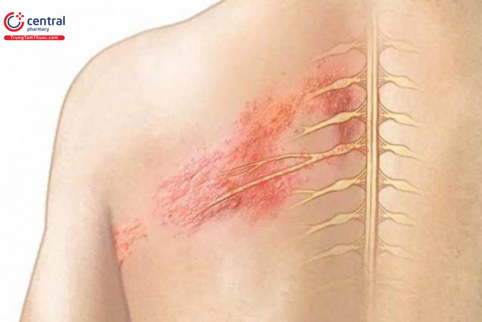 Triệu chứng điển hình của bệnh Zona