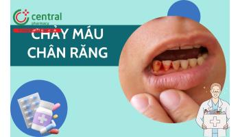 Tự nhiên chảy máu chân răng có phải cảnh báo ung thư? Cách điều trị bệnh hiệu quả 