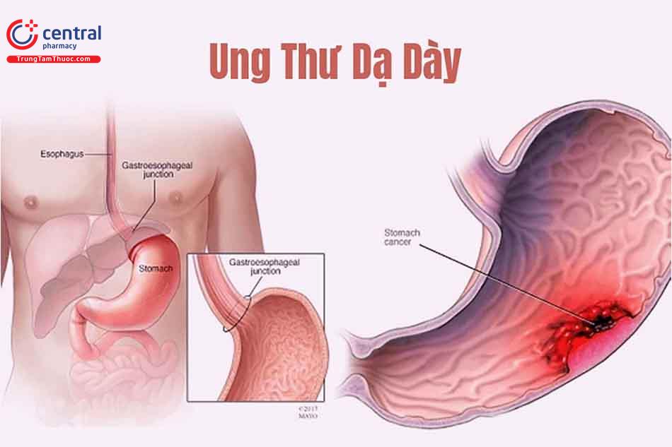 Ung thư dạ dày: nguyên nhân, dấu hiệu nhận biết sớm nhất, điều trị
