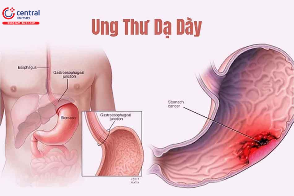 Ung thư dạ dày