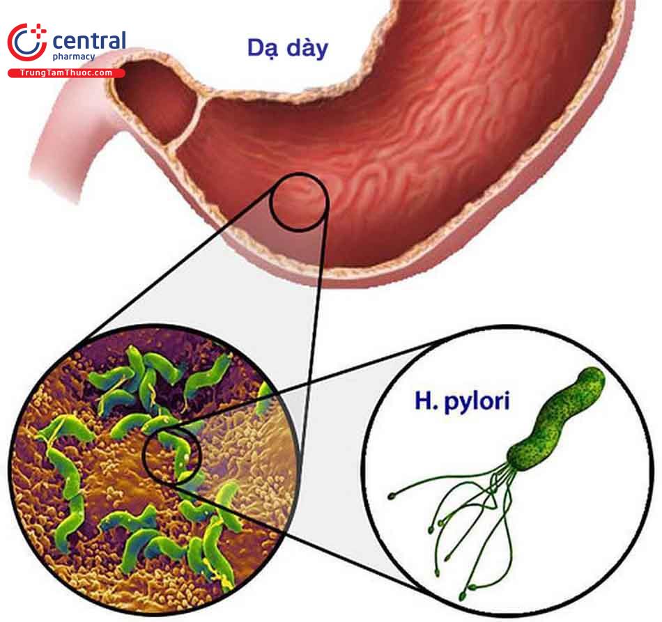 Nhiễm H. pylori có thể gây ung thư dạ dày
