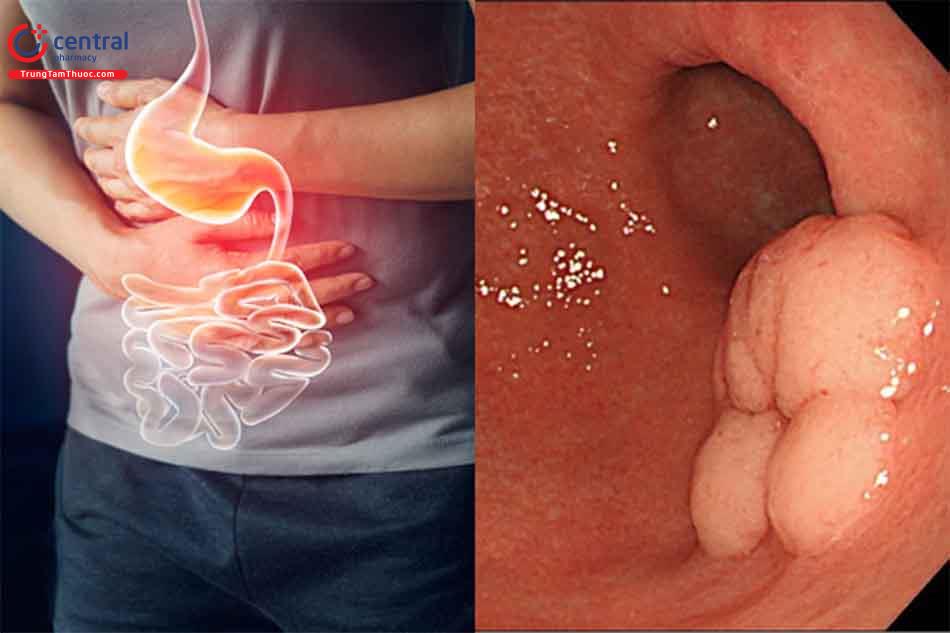 Nội soi và xét nghiệm chẩn đoán ung thư dạ dày