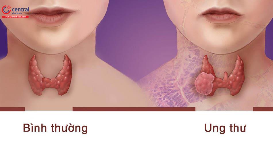 ​Ung thư tuyến giáp