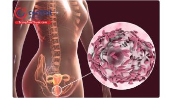 Viêm âm đạo do vi khuẩn: triệu chứng và cách điều trị bệnh