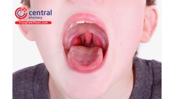 Viêm amidan ở trẻ em: nguyên nhân, triệu chứng, điều trị 