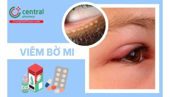 Viêm bờ mi bao lâu thì khỏi? Nguyên nhân, triệu chứng và cách điều trị hiệu quả tại nhà