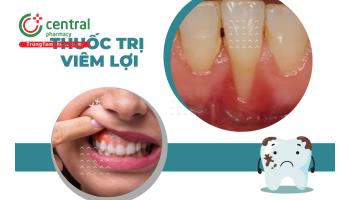 Viêm lợi sưng má uống thuốc gì? Thuốc trị viêm lợi, viêm chân răng an toàn và hiệu quả 