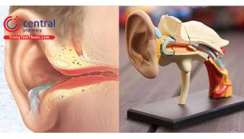 Viêm tai giữa mạn tính có cholesteatoma: nguyên nhân và điều trị