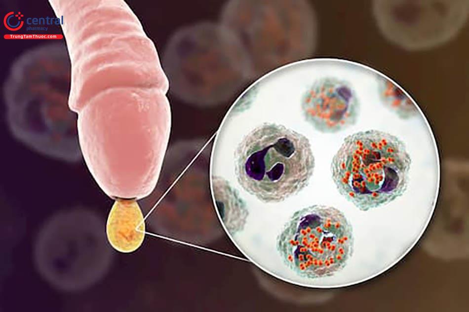 Viêm bao quy đầu do nhiễm khuẩn