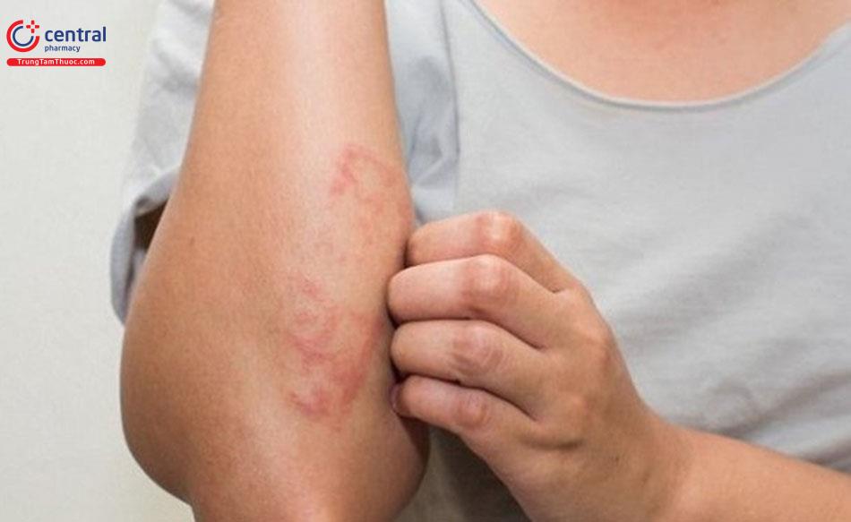 Hình ảnh viêm da cơ địa người lớn