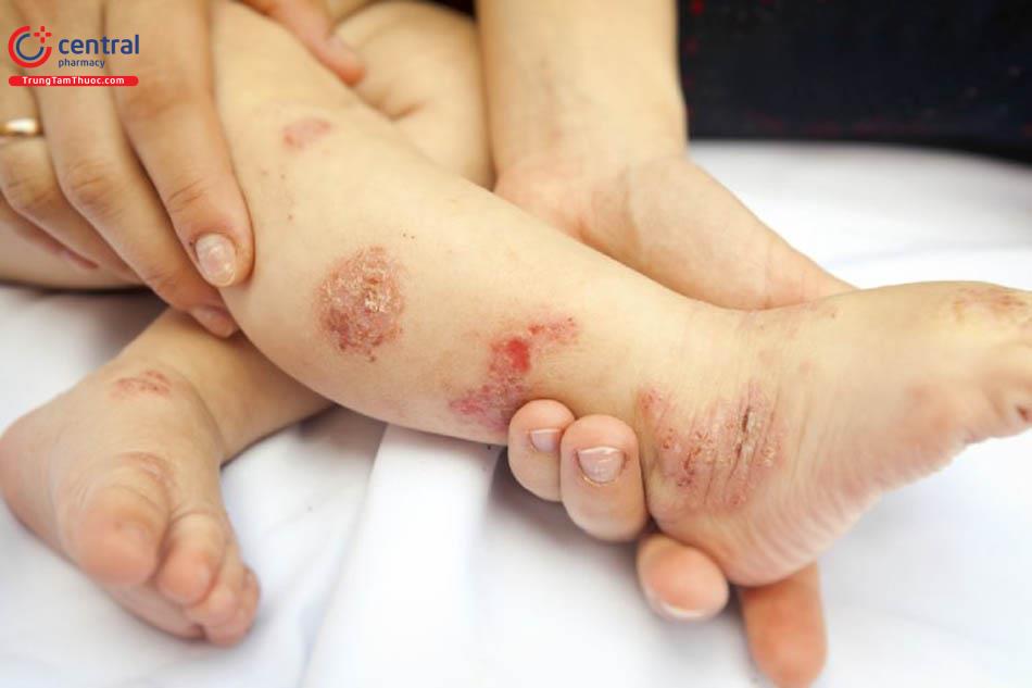 Hình ảnh viêm da cơ địa trẻ em