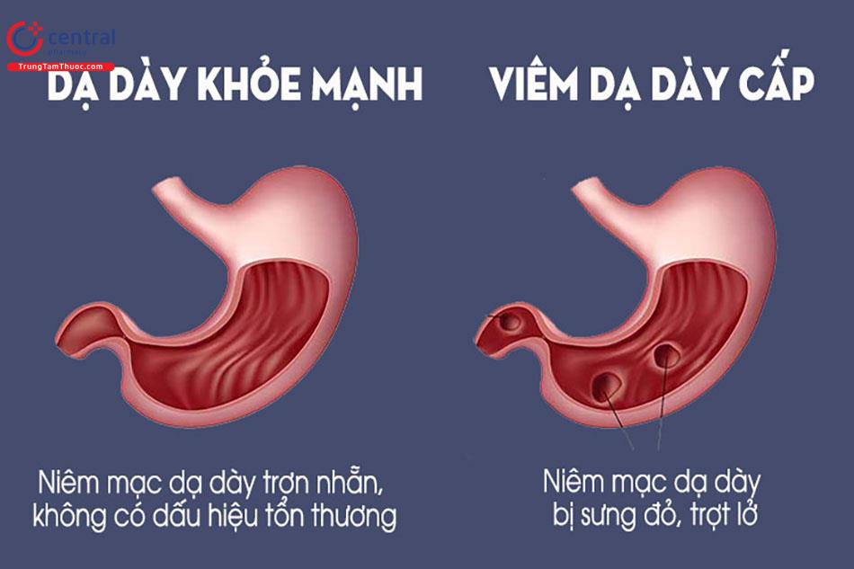 Viêm dạ dày cấp