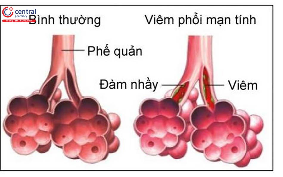 Viêm phổi mạn tính