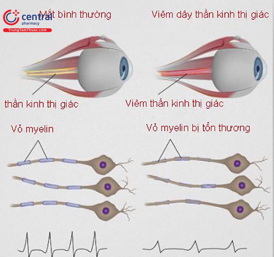 Viêm thần kinh thị giác do dùng thuốc điều trị lao