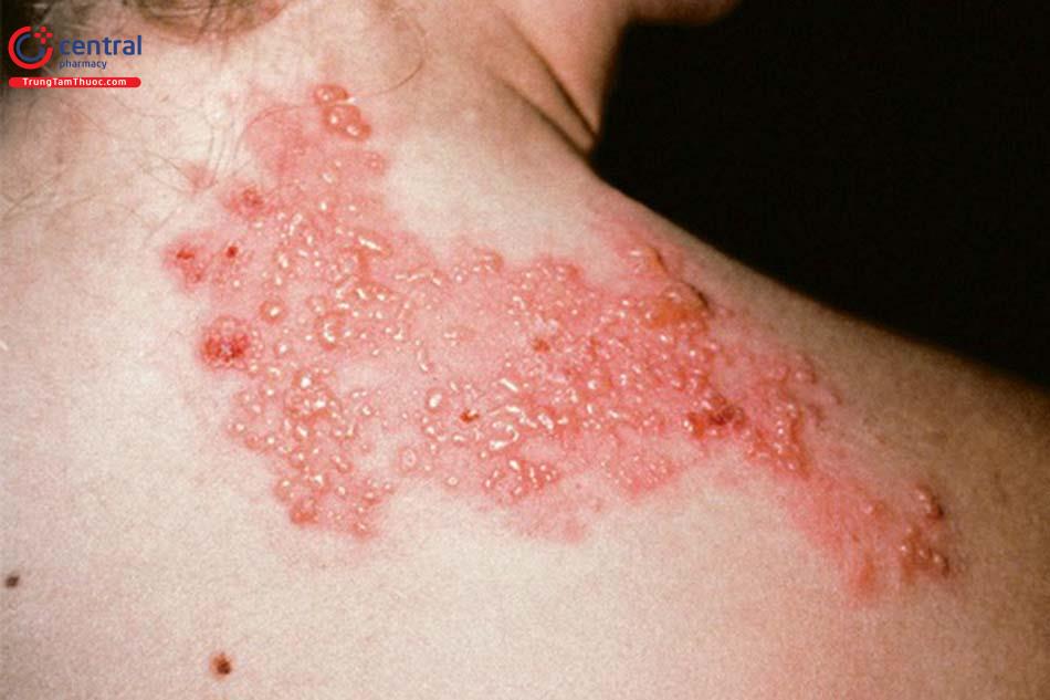 Hình ảnh bệnh Zona